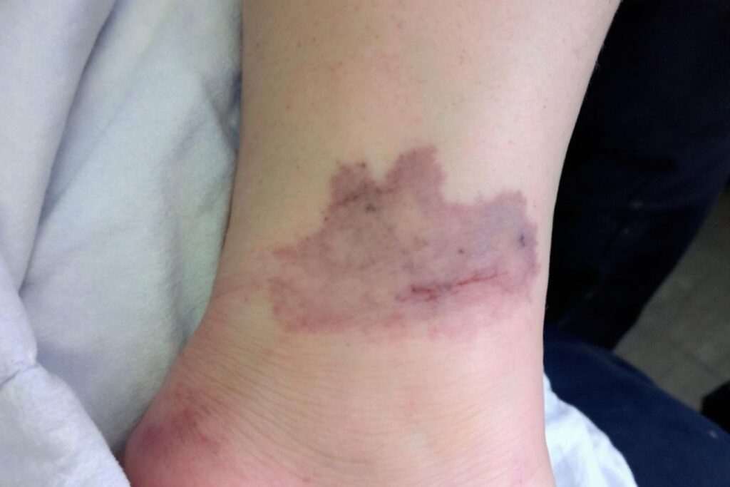 Boule sur le tendon d&rsquo;Achille : causes et solutions